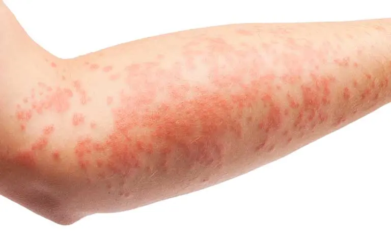 About Atopic dermatitis 4
