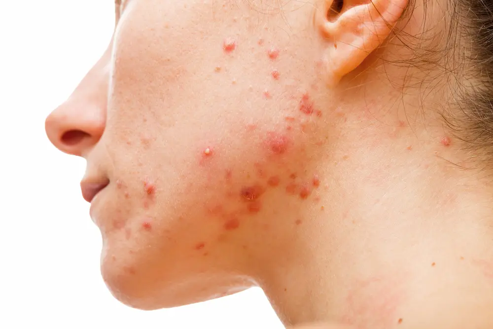 Acne share