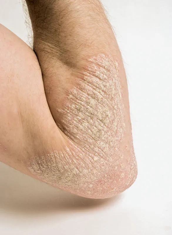 Psoriasis elbow