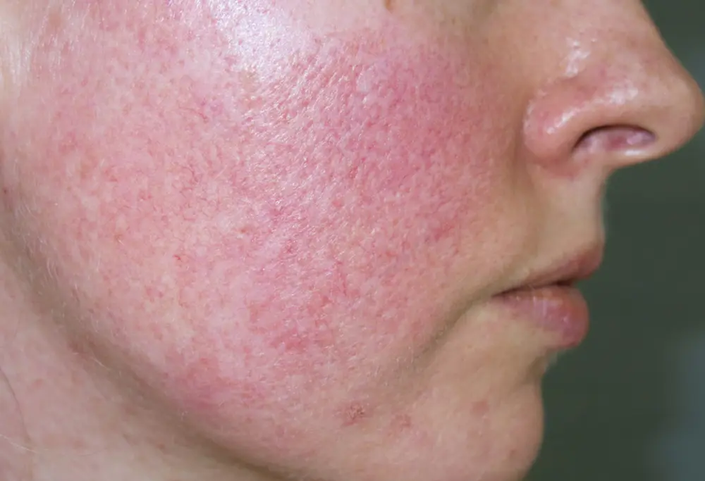acne rosacea che cose come si forma cause e cure