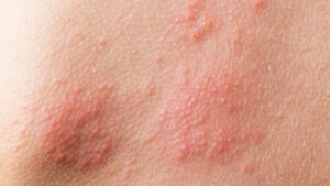 Picture of eczema skin