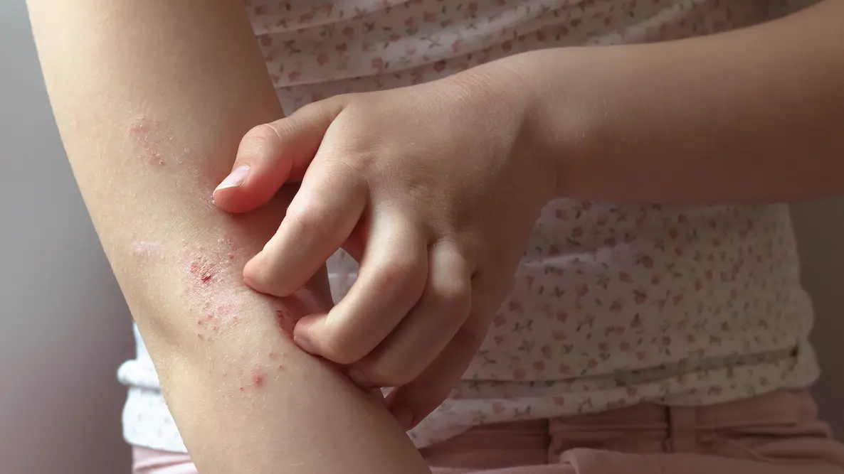 scratching eczema on arm 1314008576