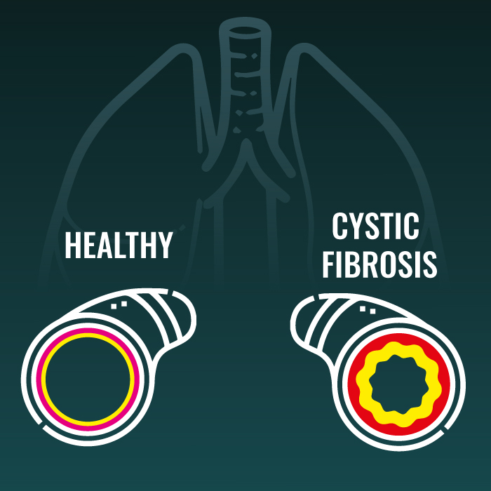 Graphic of lungs with showing healthy vs cystic fibrosis in lungs