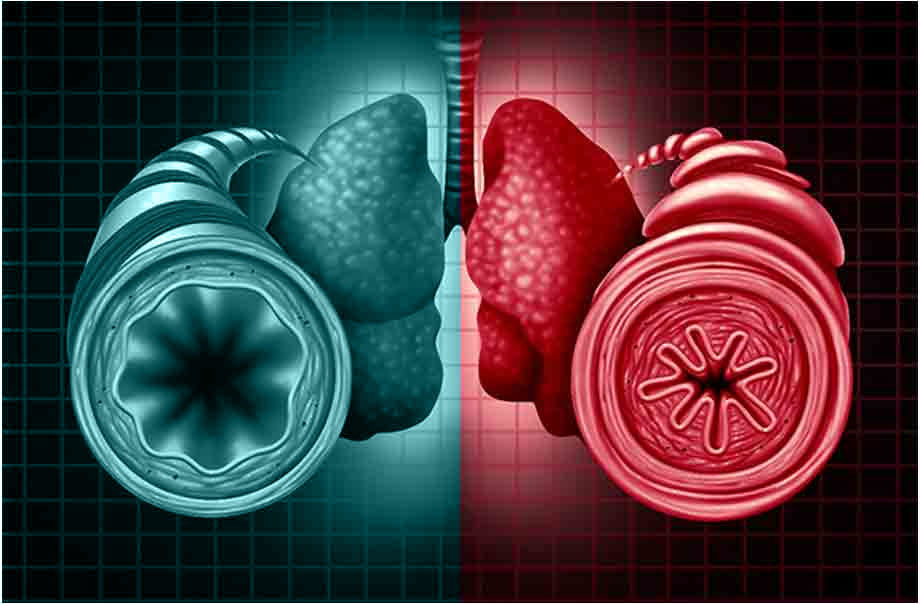 Image of lungs showing one half healthy and other being affected with conditions