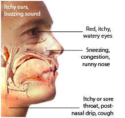 Image of mans head showing allergic Rhinitis